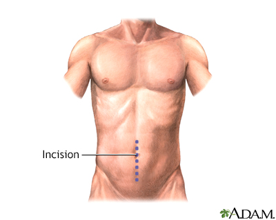 Incision