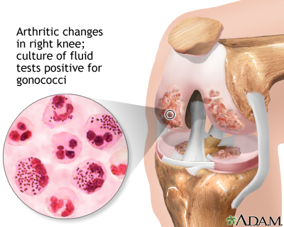 Gonococcal arthritis