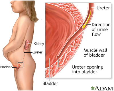 Vesicoureteral reflux
