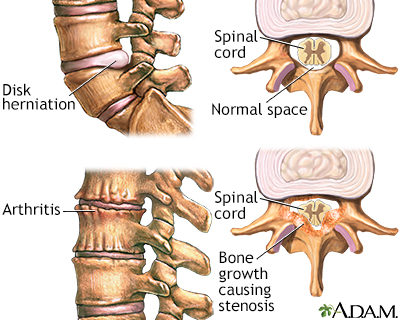 Back pain - age factors