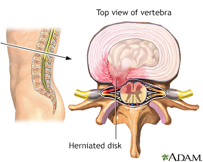Herniated disk