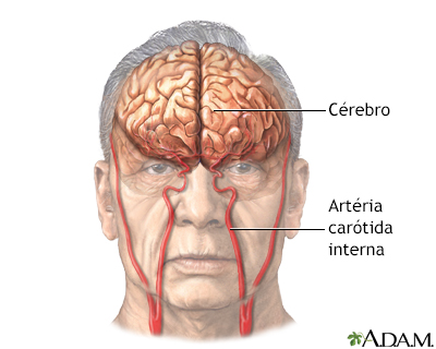 Accidente cerebrovascular - Serie