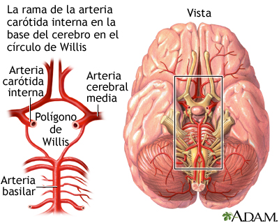 Accidente cerebrovascular - Parte 2