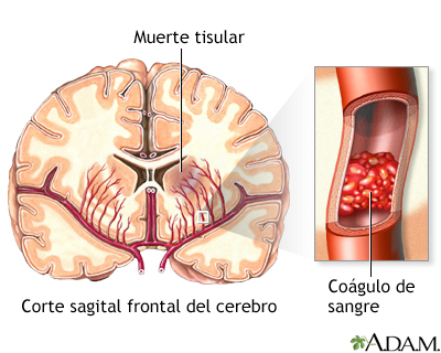 Accidente cerebrovascular - Parte 4
