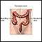 Large bowel resection - series