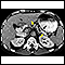 Tomografía computarizada - pancreatitis crónica