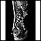 Teratoma - IRM
