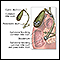 Coledocolitiasis