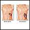 Esplenomegalia