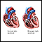 Regurgitación tricuspídea