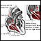 Regurgitación tricuspídea