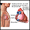 Pericarditis bacteriana