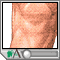 Osteoartritis