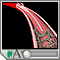 Angioplastia con balón - segmento corto