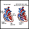 Canal auriculoventricular (defecto de relieve endocárdico)