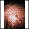 Queratosis actínica en el cuero cabelludo