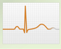Electrocardiogram  - ECG - what the tracing tells your doctor