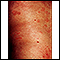 Ronchas (urticaria) en el tronco