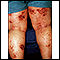 Dermatitis - atópica de las piernas