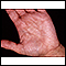 Hiperlinearidad de la dermatitis atópica