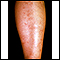 Poliarteritis microscópica 2