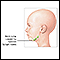 Protuberancia en el cuello